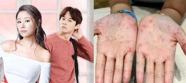 明星带伤拍戏,明星带伤坚持拍摄的感人瞬间